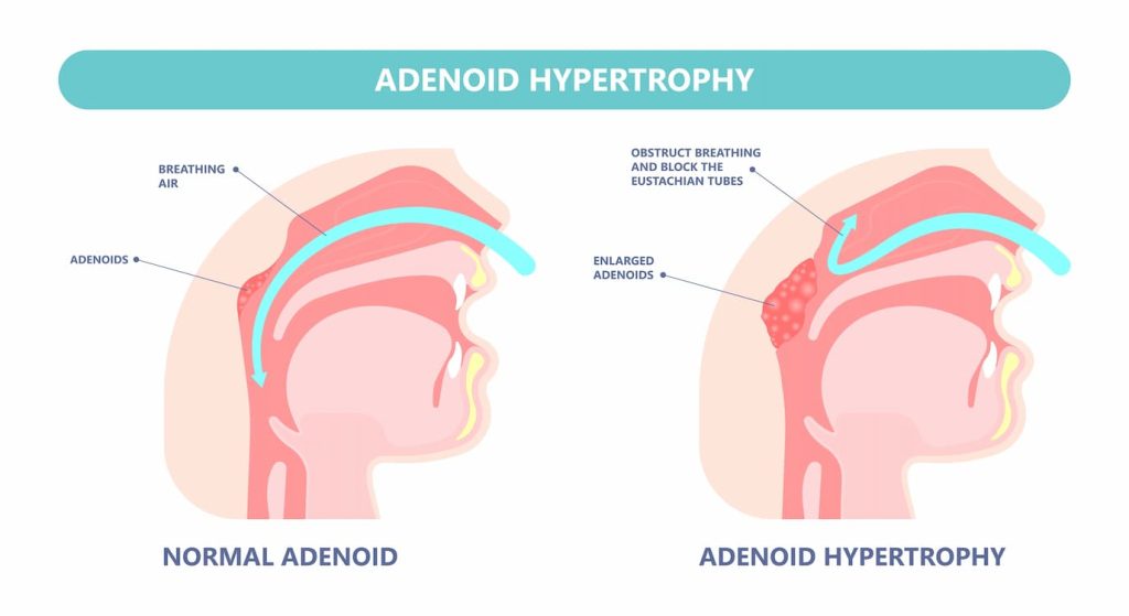 Diagram showing enlarged adenoids at the back of the nose above the throat
